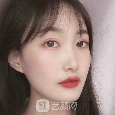 成都美莱黄小林双眼皮修复怎么样？90天修复细节图一览