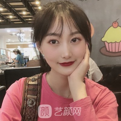 成都美莱黄小林双眼皮修复怎么样？90天修复细节图一览