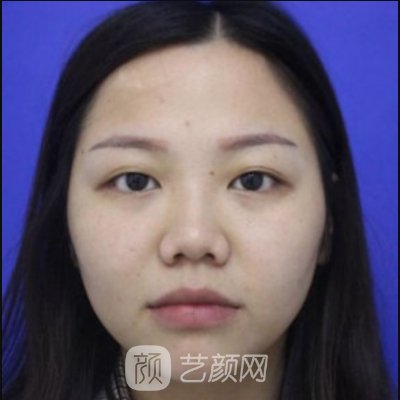 重庆华美彭绍宗做鼻子怎么样？亲身体验实例曝光