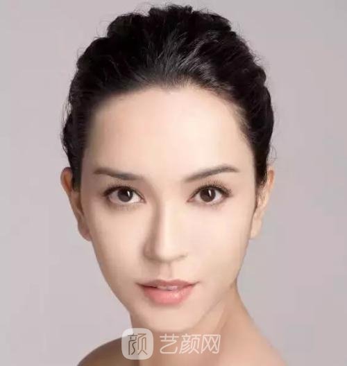 伊婉c适合填充哪里？伊婉c玻尿酸维持时间是多久？