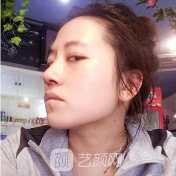 四川友谊李萍隆鼻实例，术后颜值都提升了一大截