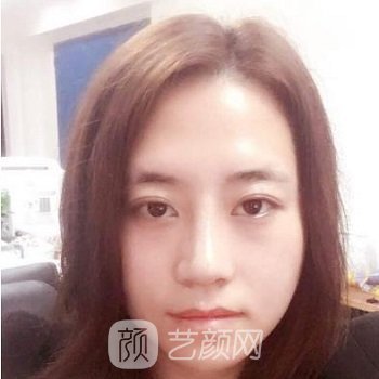 四川友谊李萍隆鼻实例，术后颜值都提升了一大截