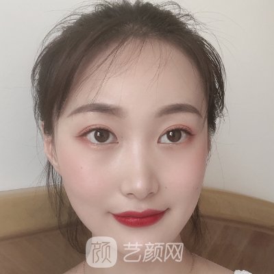 佛山华美整形医院割双眼皮好吗?80天体验实例公布