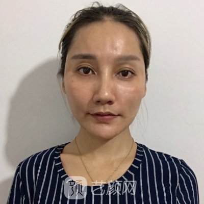 深圳虞美人医疗美容医院热玛吉抗衰实例上线|附对比图