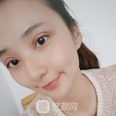 南阳袁恺阳医生做双眼皮怎么样?亲身体验实例公开