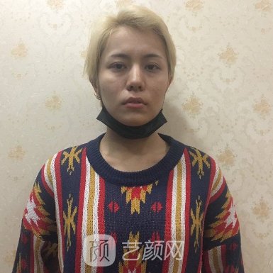  郑大一附院张建文隆胸实例曝光成果自然无痕