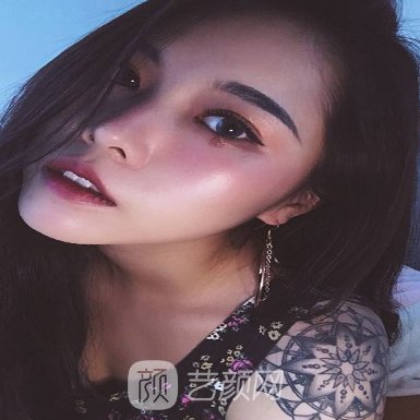 北京李敏做修复双眼皮怎么样? 2023全新体验实例公布