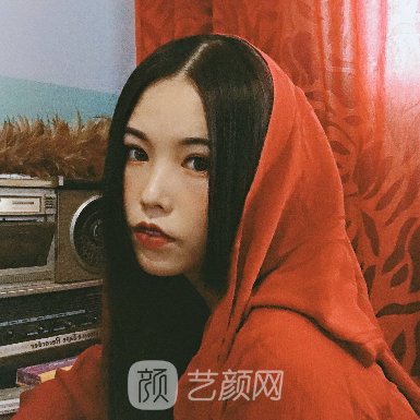 北京李敏做修复双眼皮怎么样? 2023全新体验实例公布