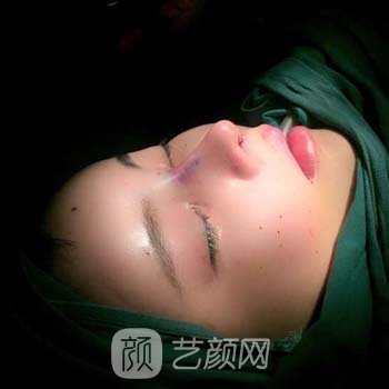 陈富全3A隆鼻实例，专利技术打造个性化鼻部形态