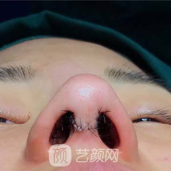 陈富全3A隆鼻实例，专利技术打造个性化鼻部形态