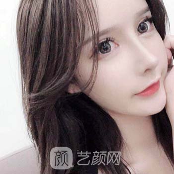 陈富全3A隆鼻实例，专利技术打造个性化鼻部形态