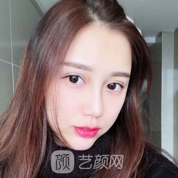 翟晓梅隆鼻实例，修复之后的成果特别满意，绝绝子