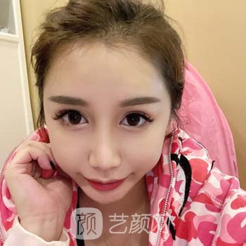 翟晓梅隆鼻实例，修复之后的成果特别满意，绝绝子