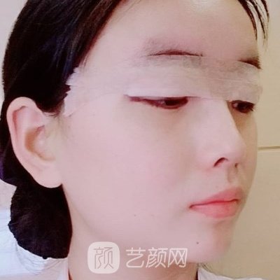 杭州连天美整形医院正规吗?2023双眼皮体验实例一览