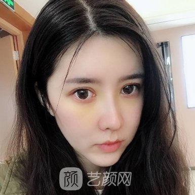 深圳名丽医疗美容医院怎么样?全新面部脂肪填充实例公布