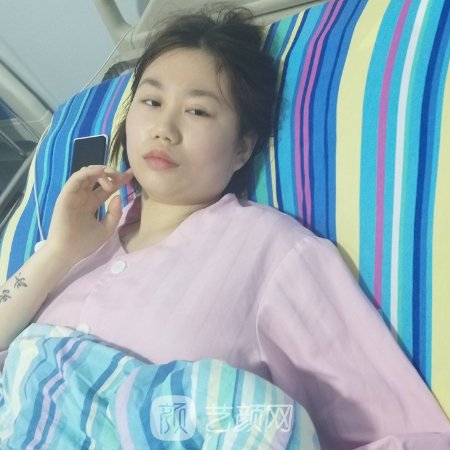长沙美莱整形医院吸脂实例展示|附亲身体验对比图