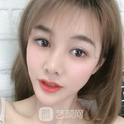 北京美莱整形医院正规吗?全新双眼皮实例公布