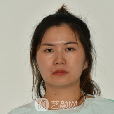 深圳名丽医疗美容医院怎么样?2023光子嫩肤实例一览