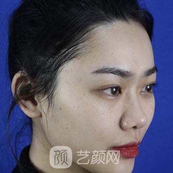 临安芘丽芙医院正规吗？座鼻子怎么样？附隆鼻实例