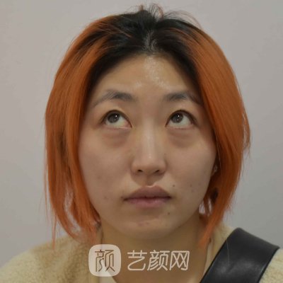 北京伊美尔秦宏伟去眼袋实例公开|成果自然无痕