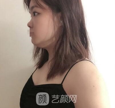 石家庄美莱整形医院好吗？技术怎么样？假体隆胸实例展示