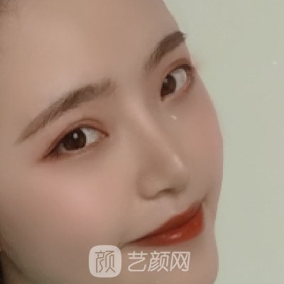 呼和浩特京美整形医院隆鼻实例出炉|80天体验实例出炉