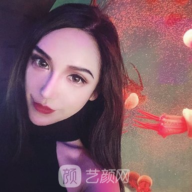 怀化艾美莉整形医院口碑好吗?崭新双眼皮实例公布