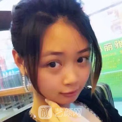 广州华美高顺福做鼻子怎么样?医生实力及实例曝光