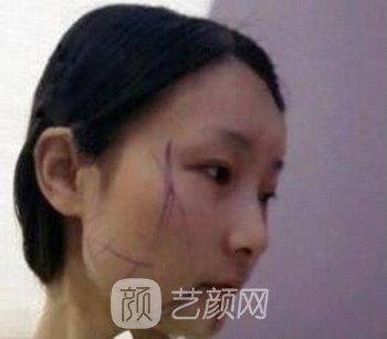 李志海磨骨失败修复实例，面部线条很流畅，线条感非常明显