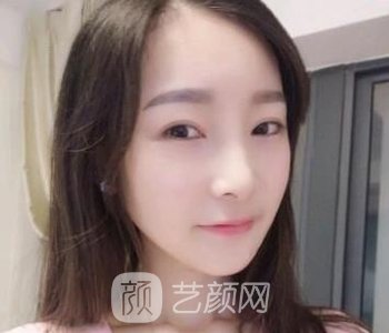 李志海磨骨失败修复实例，面部线条很流畅，线条感非常明显