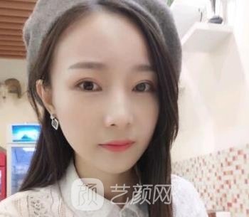 李志海磨骨失败修复实例，面部线条很流畅，线条感非常明显