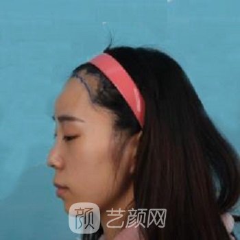 杭州雍禾张东宏发际线移植实例，手术前后对比图照片差别很大