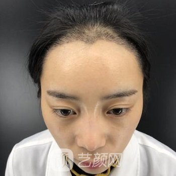 杭州雍禾张东宏发际线移植实例，手术前后对比图照片差别很大