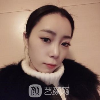 杭州雍禾张东宏发际线移植实例，手术前后对比图照片差别很大
