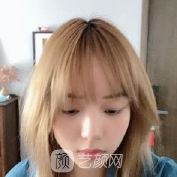 无锡雍禾雷舟头顶加密实例收费价目表，拥有浓密毛发