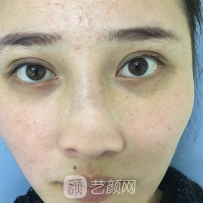 北京爱彼医疗美容怎么样？崭新光子嫩肤实例发布