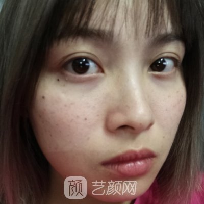 深圳恒生医院整形科光子嫩肤实例公开|成果自然无痕