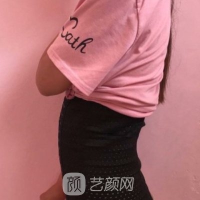 南宁熠美整形医院好不好？全新吸脂实例展示