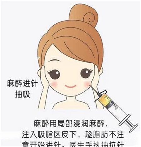 余恩旭脂肪填充怎么样？据网友反馈技术ok~性价比还高