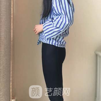 南通韩美俞晓鹏吸脂减肥怎么样？医生简介+大腿吸脂实例