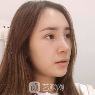 义乌艺星医疗美容医院怎么样?全新双眼皮体验实例发布