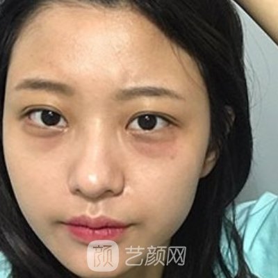 深圳李天石医生做眼袋怎么样？医生招牌实例上线