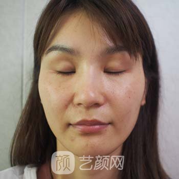 义乌连天美王馨婉割双眼皮实例，人也变得自信了起来