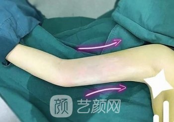 梁耀婵在北京很有名吗？医生详细介绍+手臂吸脂实例