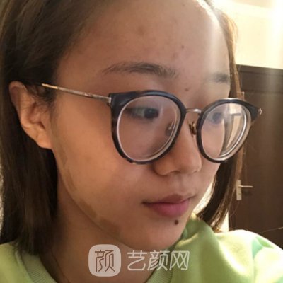 长沙雅美整形美容医院热玛吉除皱实例展示|成果自然美观