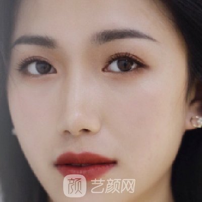 广东画美整形医院正规吗?全新热玛吉除实例一览