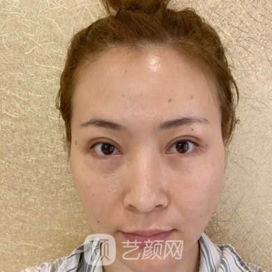 湖南妇女儿童医院整形科玻尿酸注射除皱实例展示|成果自然无痕