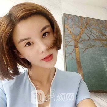 宁波艺星美容整形医院怎么样？内附面部填充实例