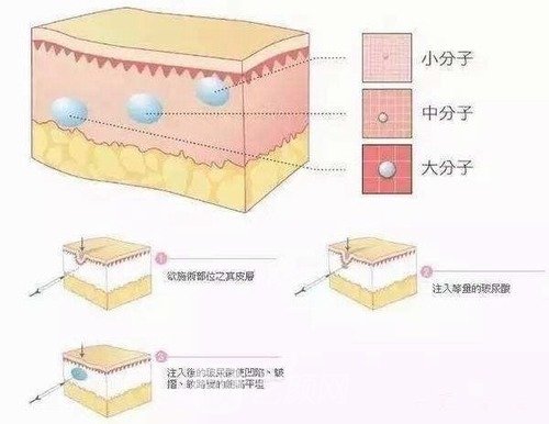 瑞蓝铂金玻尿酸是多少毫升的？维持的时间是多久？