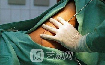 广州智媄医疗美容整形医院怎么样？腰腹吸脂实例对比图